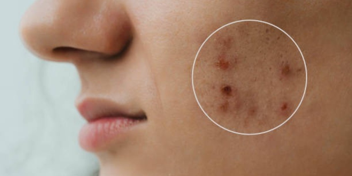 Can Laser Acne Treatment Help Prevent Future