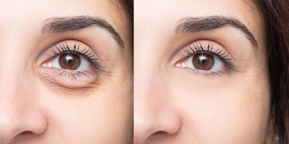 Understanding Pigmentation-Related Dark Circles