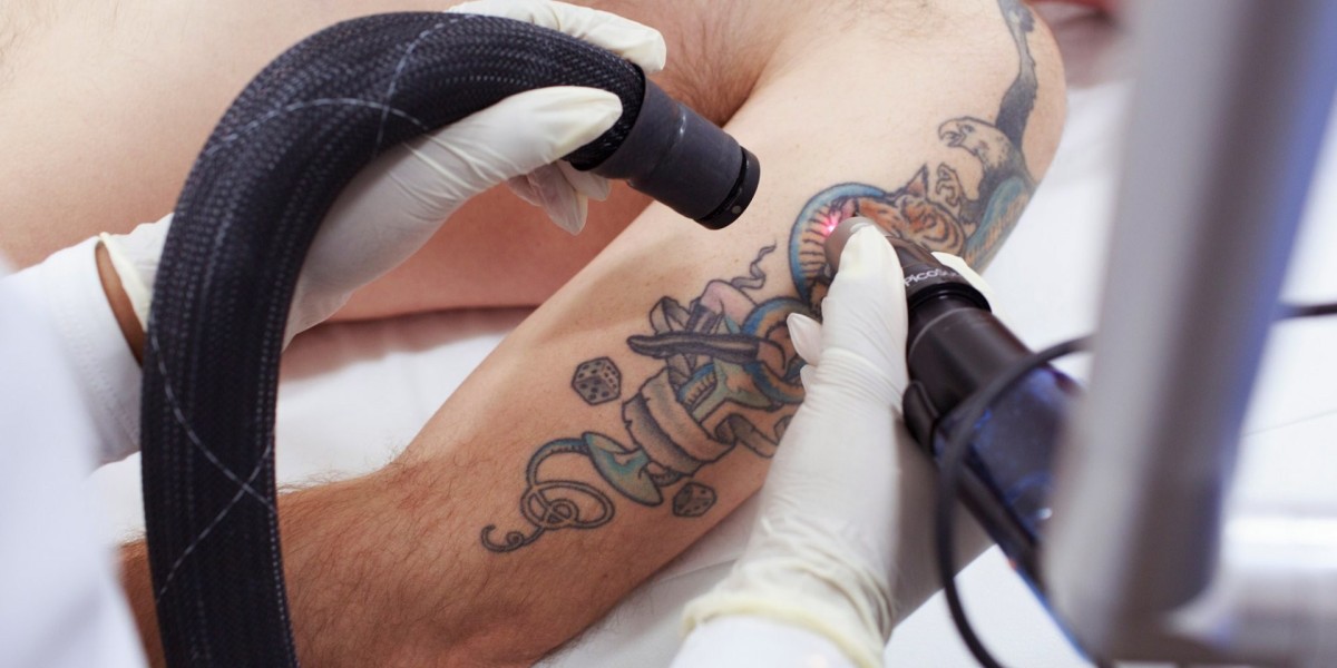 Is tattoo removal in Islamabad painful?