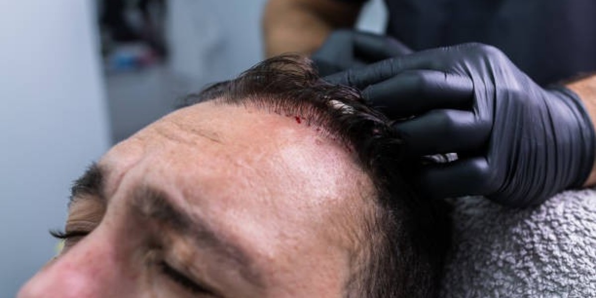 Why PRP Hair Treatment in Riyadh is Becoming