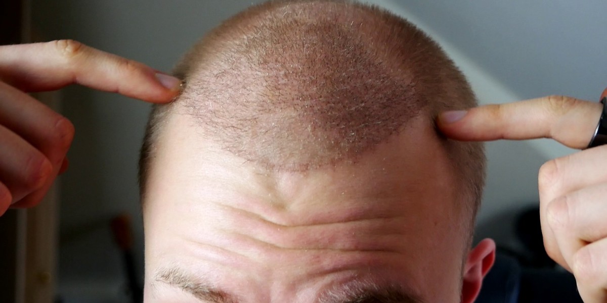 Why Dubai Leads the Middle East in Hair Cloning