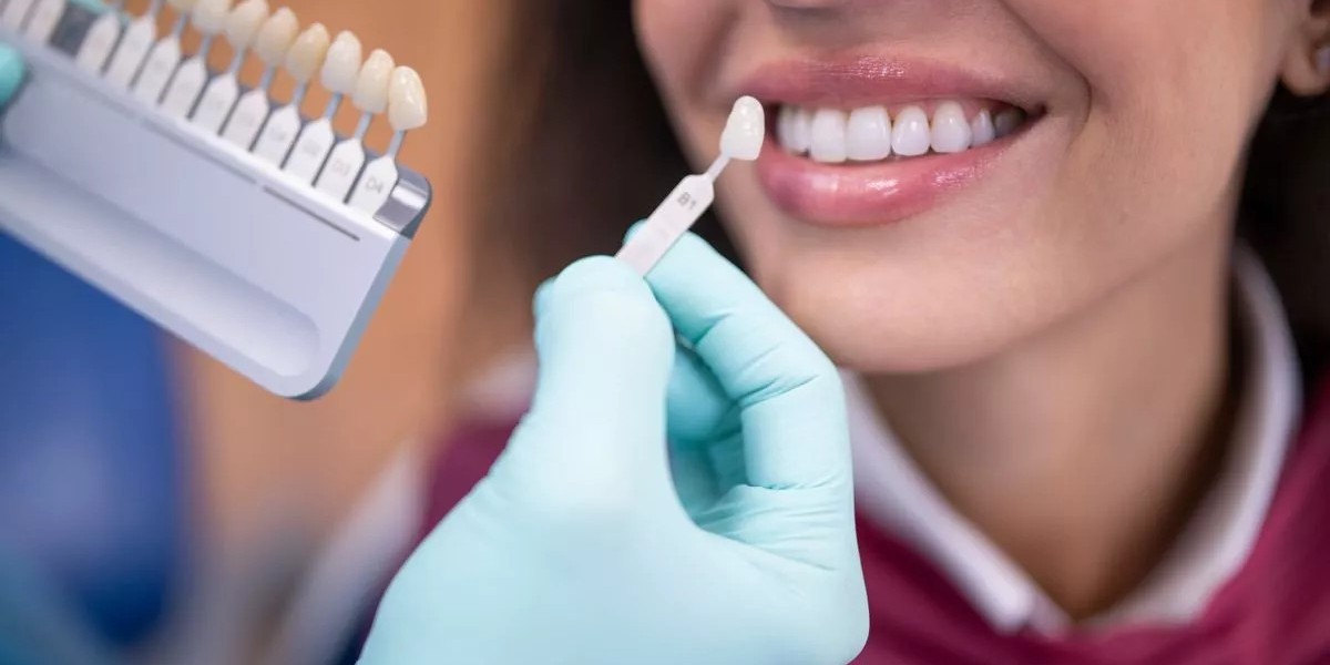 Understanding Dental Veneers in Islamabad