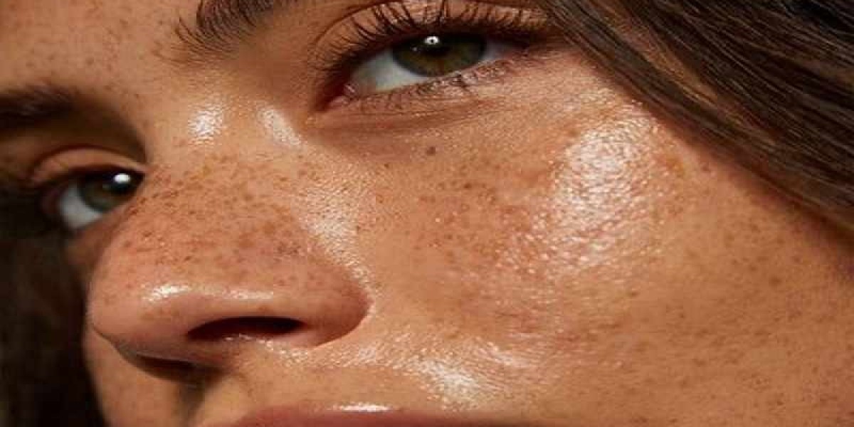 Best Cosmetic Clinics for Melasma Treatment in