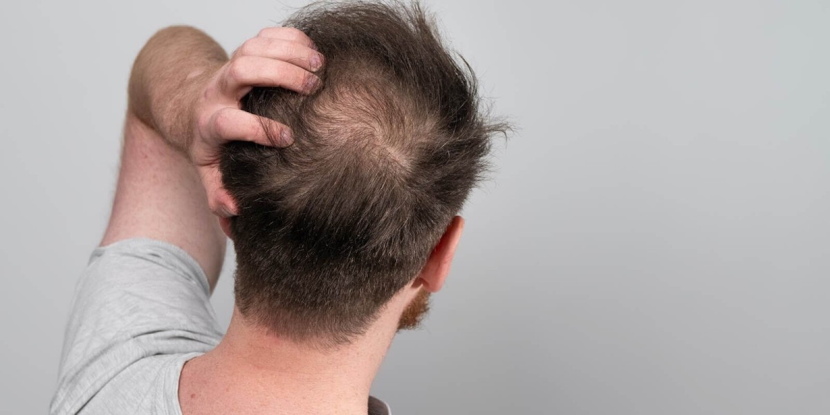 Who Can Benefit From Hair Replacement in Dubai