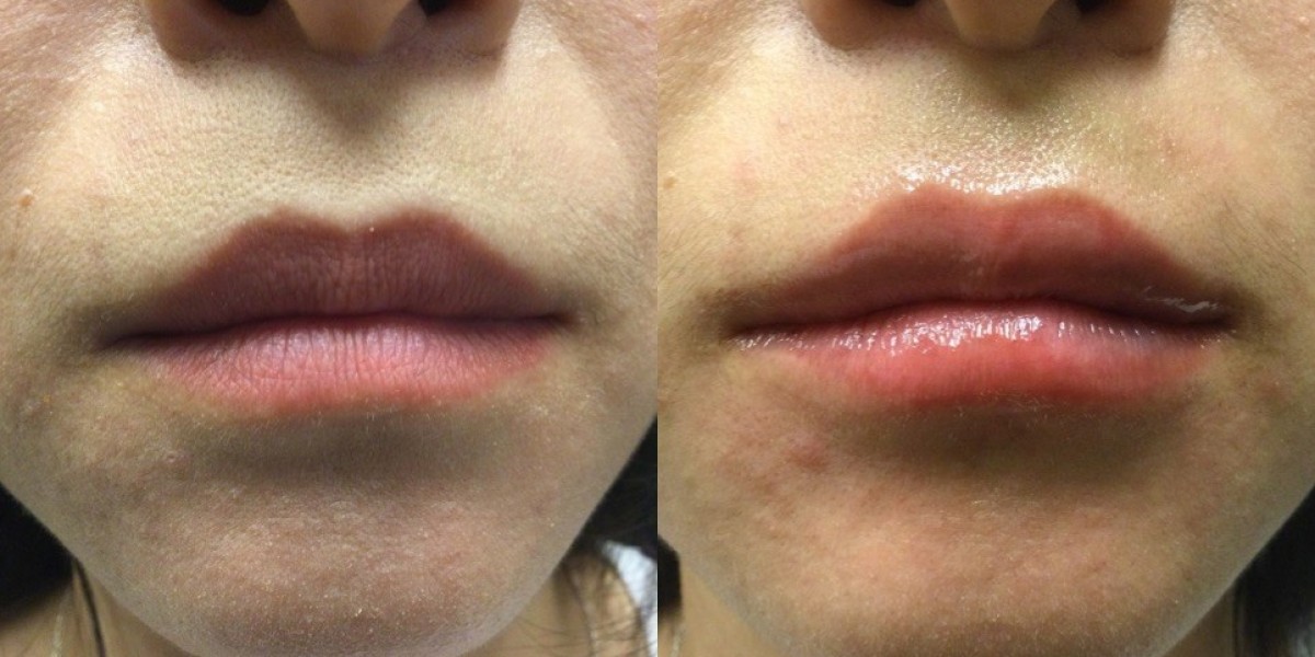 How Do Fillers Boost Facial Harmony?
