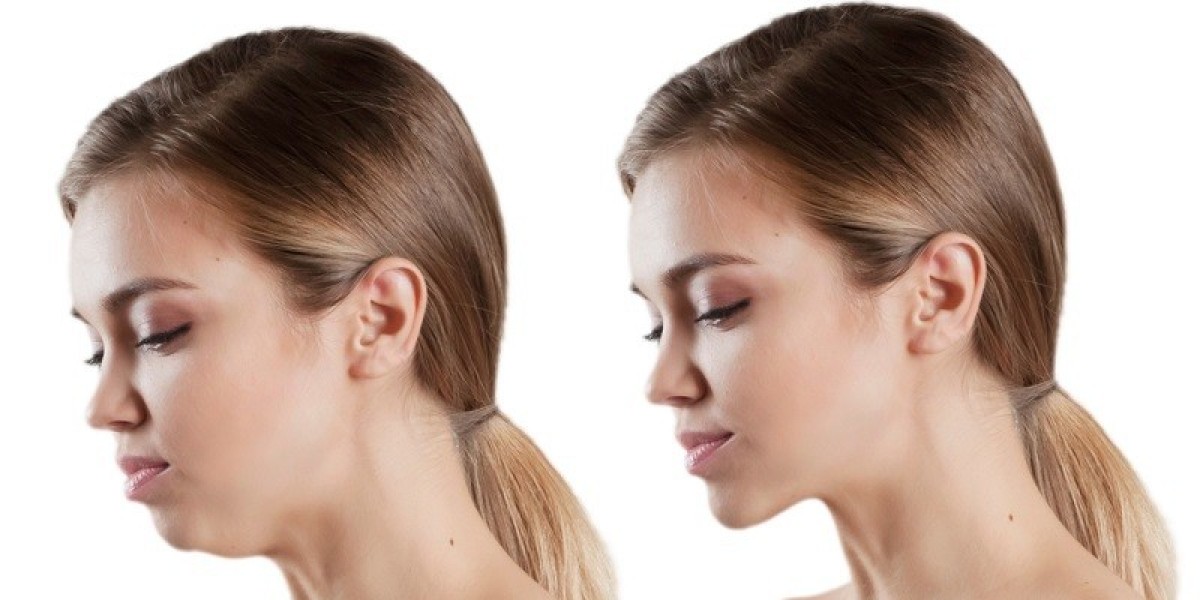 Safe and Effective Jaw Surgery in Islamabad