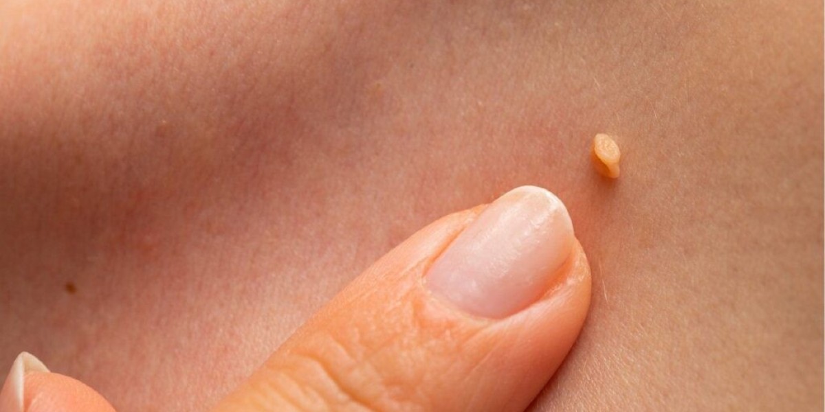 Skin Wart Removal Cost: Cost by Number of Warts