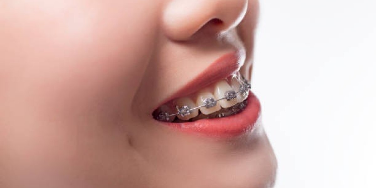 Dental Braces Cost Considerations: Maintenance