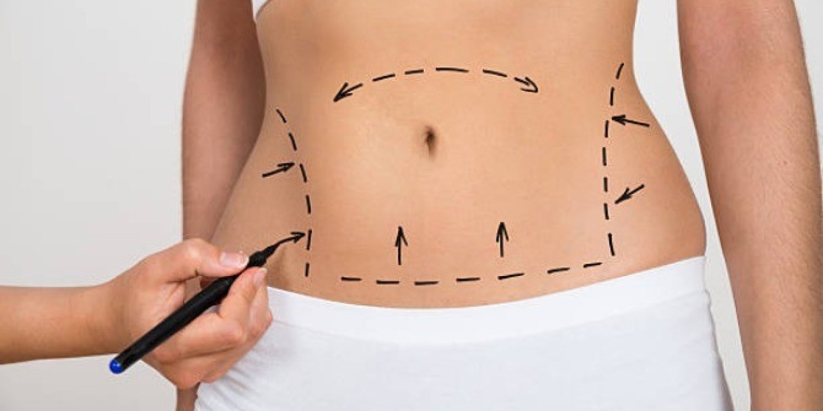 Liposuction Benefits, Process, and Recovery