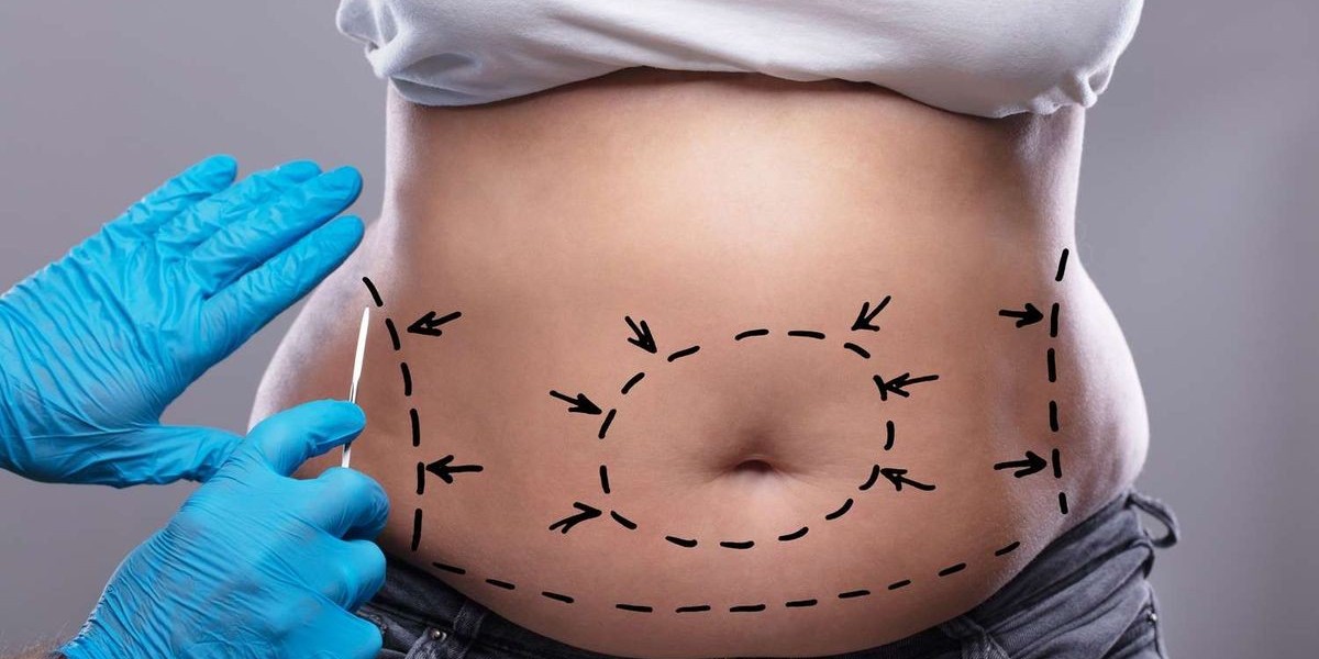 Tummy Tuck in Dubai: Personalized Care for Abdo