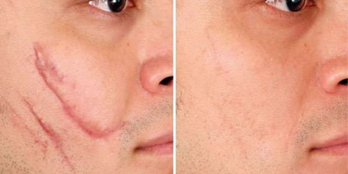 Laser Scar Removal in Dubai: Clear Path