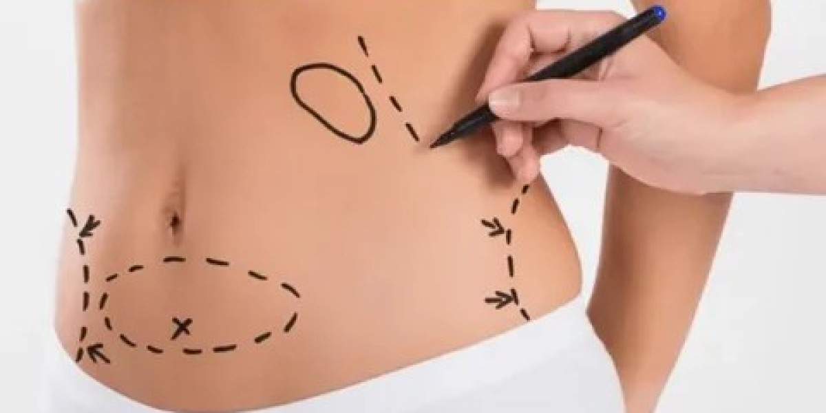 Tummy Tuck in Dubai: Achieve Definitive Body