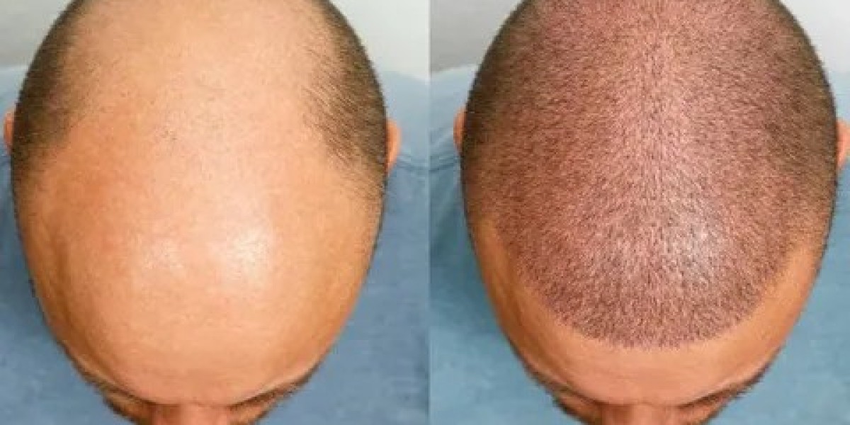 Understanding Modern Hair Transplant in Dubai