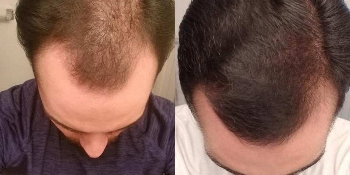 Crown Hair Transplant in Dubai: A Guide to Succ