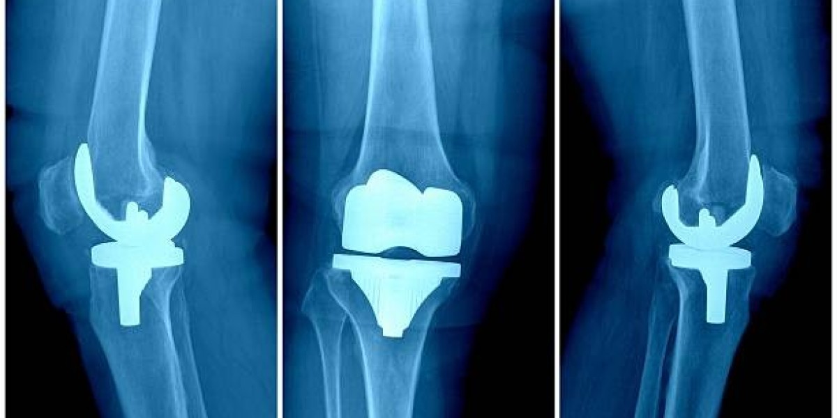 Orthopedic Reconstruction Market: Orthopedic