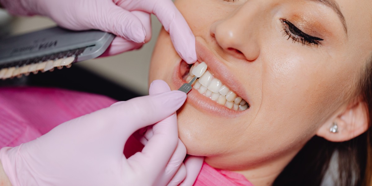 How Much Do Snap On Veneers Cost Guide
