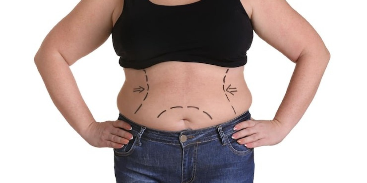 Is a Tummy Tuck in Chicago Right for You? A Com