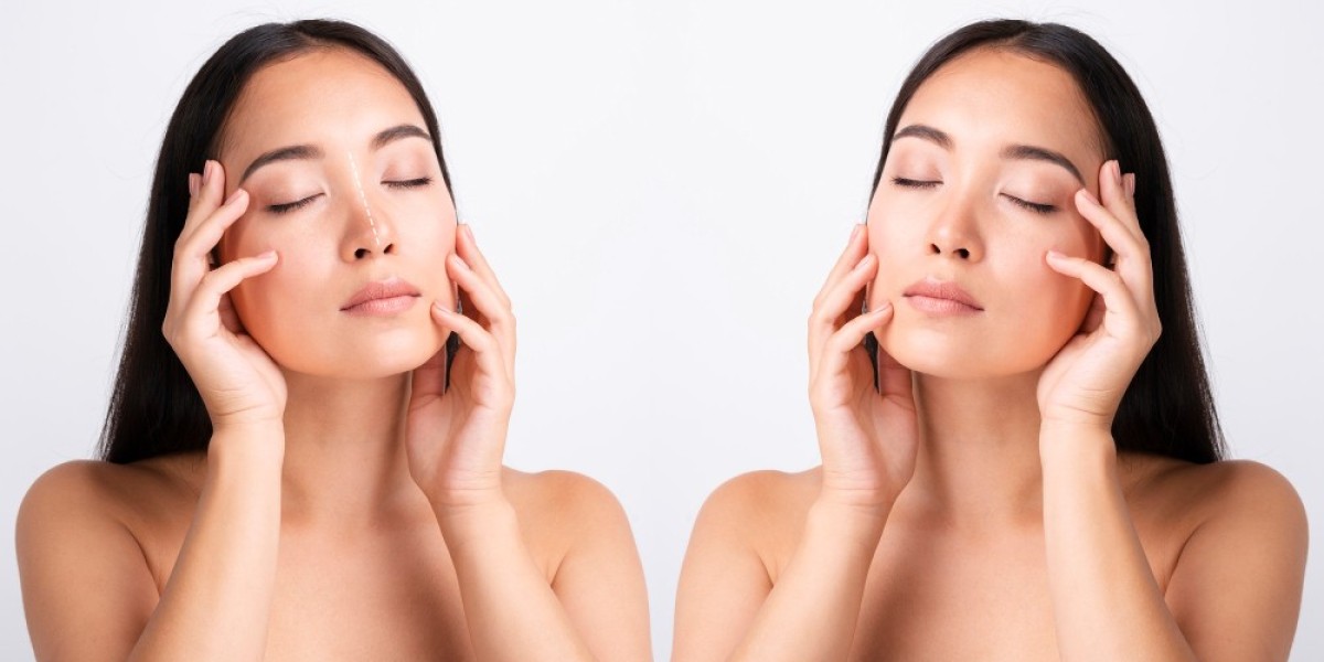HIFU vs Thread Lift: Face Lift Treatment