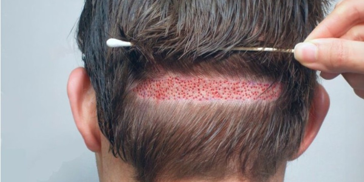 Hair Transplant in Lahore: What to Expect Befor