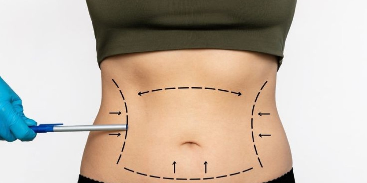 Tummy Tuck in Dubai: Defining Your Midsection