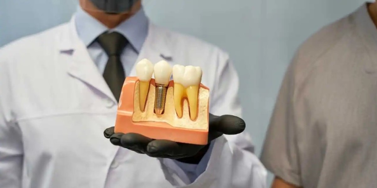 Understanding Dental Implants  in Mississauga