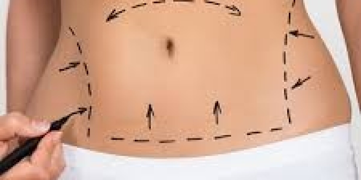 Why Choose Tajmeels Clinic for Liposuction