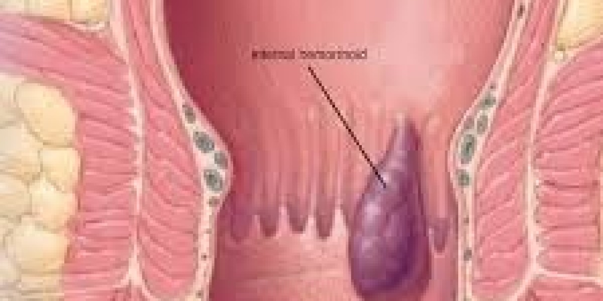 How Long Does It Take for Haemorrhoids to Heal?
