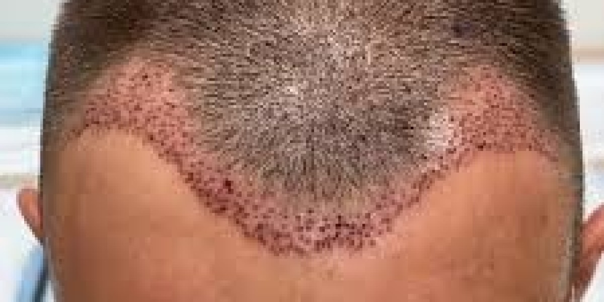 How to Choose the Right Hair Transplant Techniq
