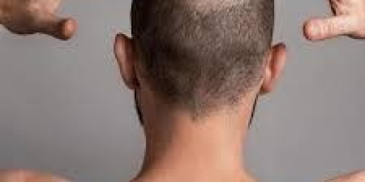 Hair Transplant in Dubai | Natural-Looking Hair