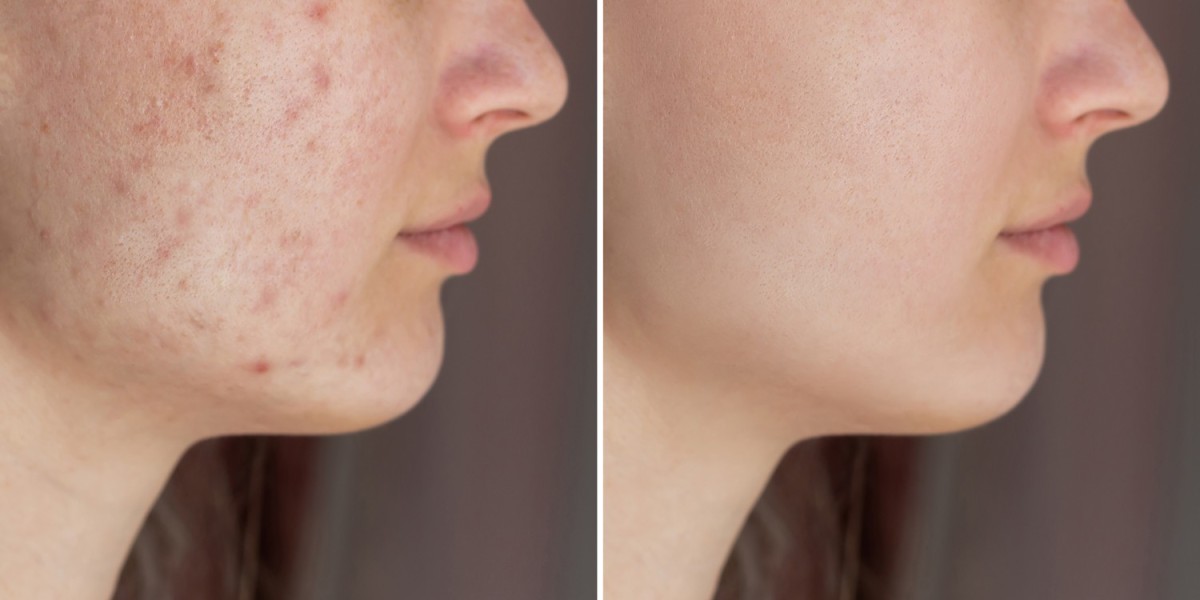 Acne Treatment Services for Clearer Skin