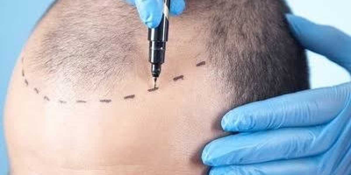 How Does a Hair Transplant in Dubai Work? A Ste