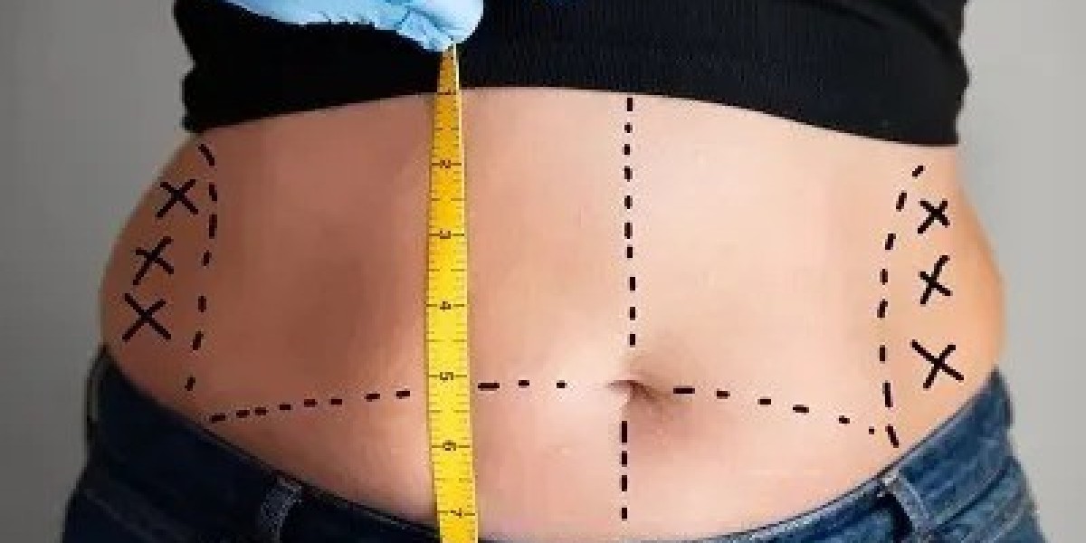 Bariatric Surgery in Islamabad