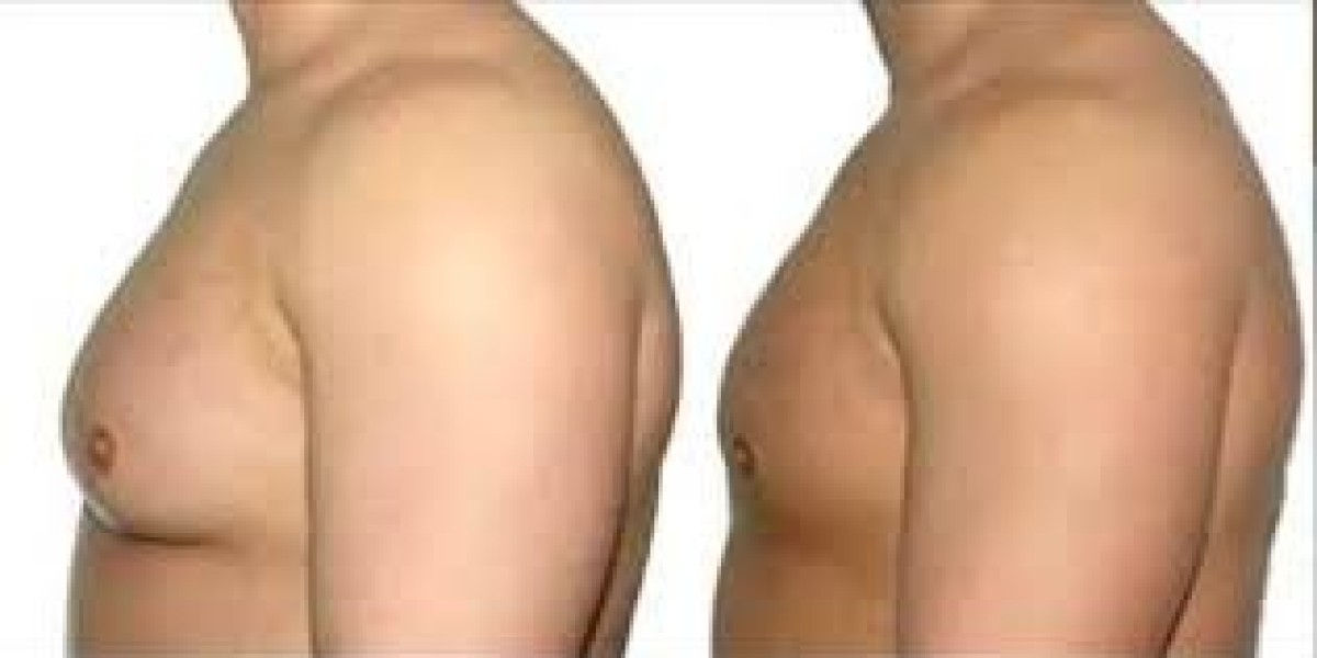 Is Gynaecomastia Surgery in Dubai Safe?