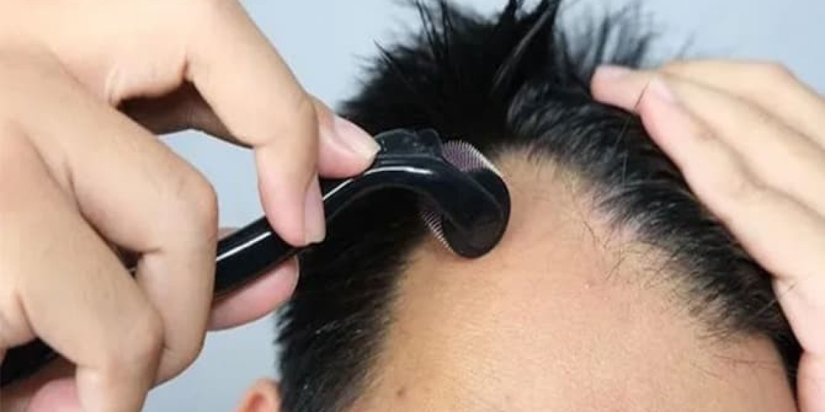 Dermaroller for Hair Loss: Does It Really Work